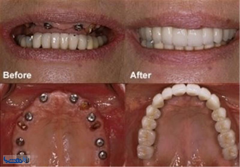 تولید نخستین ایمپلنت‌ دندان ایرانی 